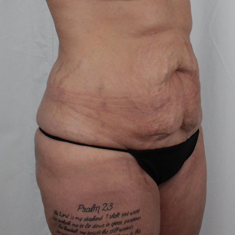Tummy Tuck Before & After Gallery - Patient 215219 - Image 3