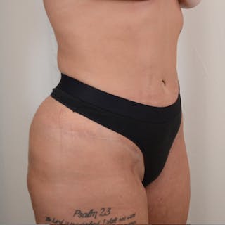 Tummy Tuck Before & After Gallery - Patient 215219 - Image 4