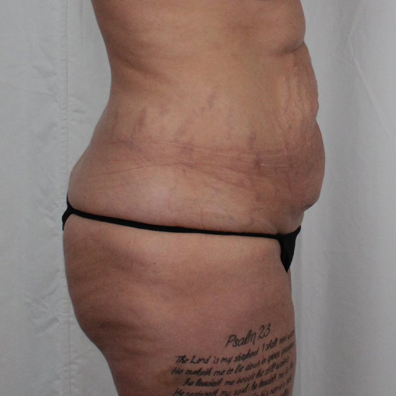 Tummy Tuck Before & After Gallery - Patient 215219 - Image 5
