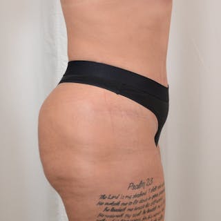 Tummy Tuck Before & After Gallery - Patient 215219 - Image 6