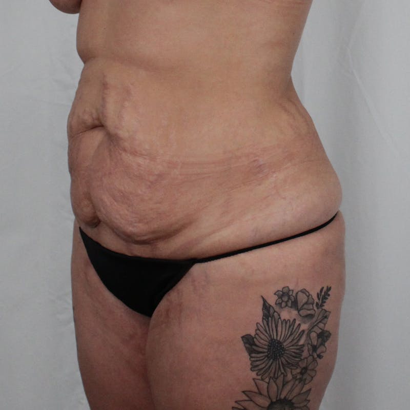 Tummy Tuck Before & After Gallery - Patient 215219 - Image 7
