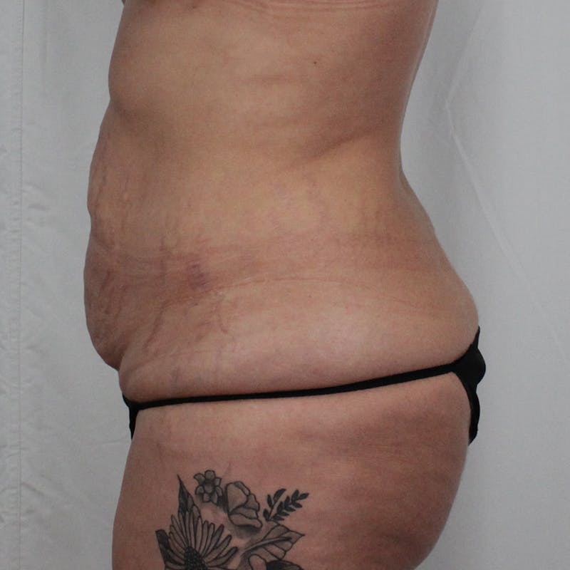 Tummy Tuck Before & After Gallery - Patient 215219 - Image 9