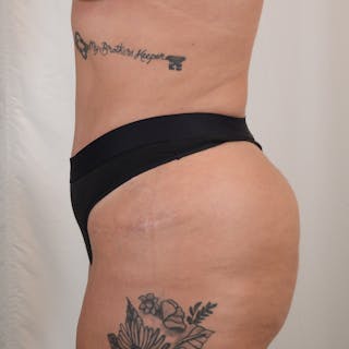Tummy Tuck Before & After Gallery - Patient 215219 - Image 10