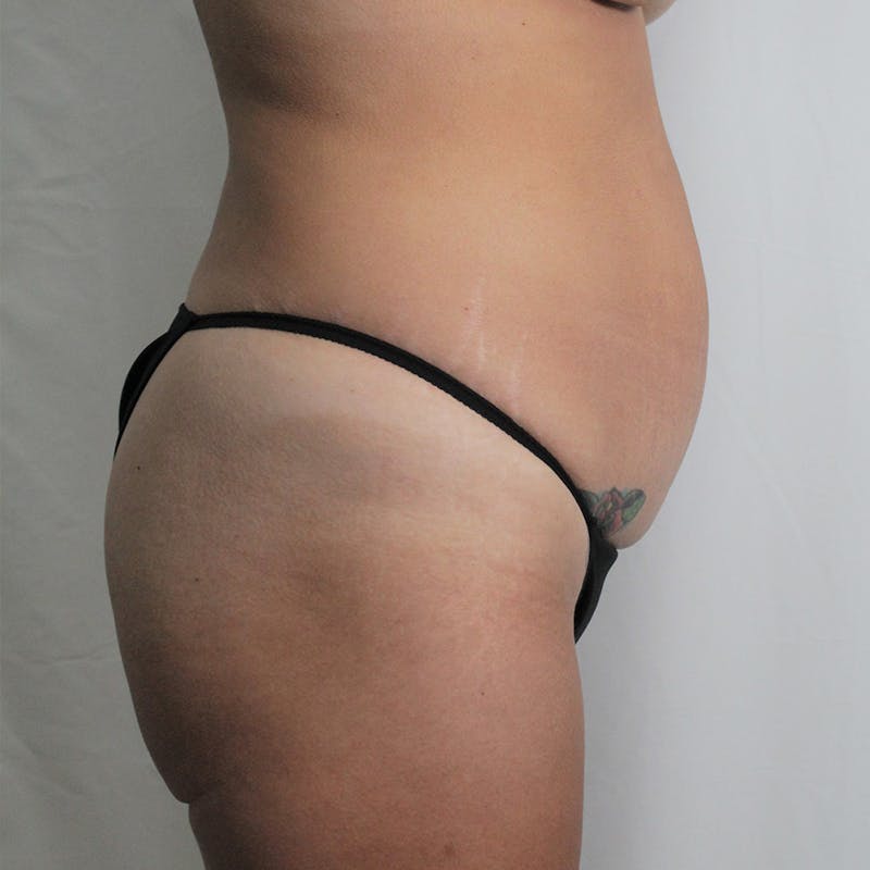 Tummy Tuck Before & After Gallery - Patient 389177 - Image 3