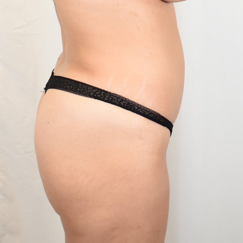 Tummy Tuck Before & After Gallery - Patient 389177 - Image 4