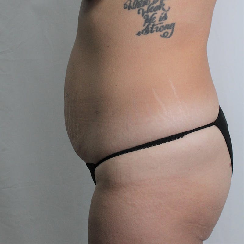 Tummy Tuck Before & After Gallery - Patient 389177 - Image 5
