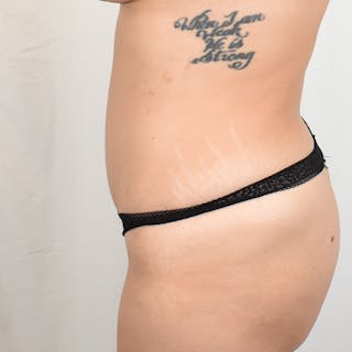 Tummy Tuck Before & After Gallery - Patient 389177 - Image 6