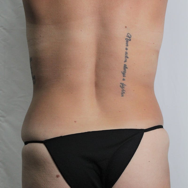 Tummy Tuck Before & After Gallery - Patient 389177 - Image 7