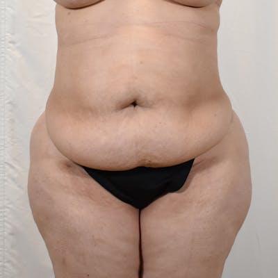 Tummy Tuck Before & After Gallery - Patient 293804 - Image 1