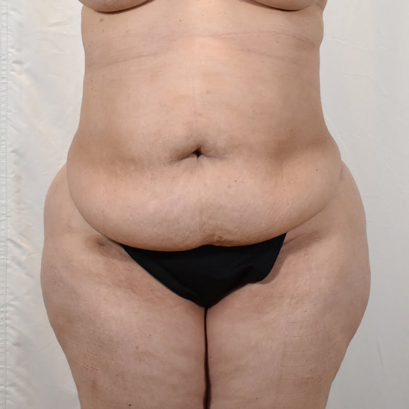 Tummy Tuck Before & After Gallery - Patient 293804 - Image 1