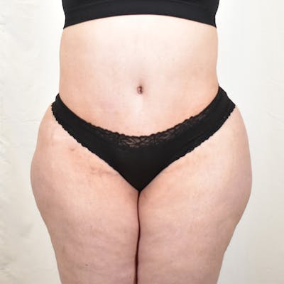Tummy Tuck Before & After Gallery - Patient 293804 - Image 2