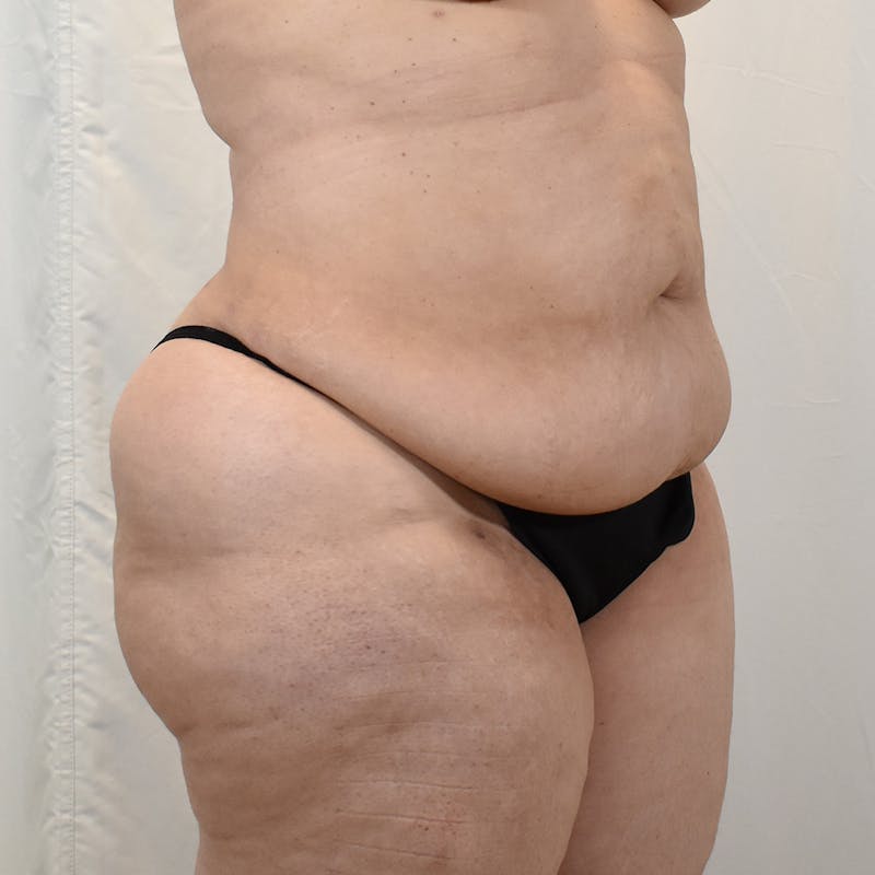 Tummy Tuck Before & After Gallery - Patient 293804 - Image 3