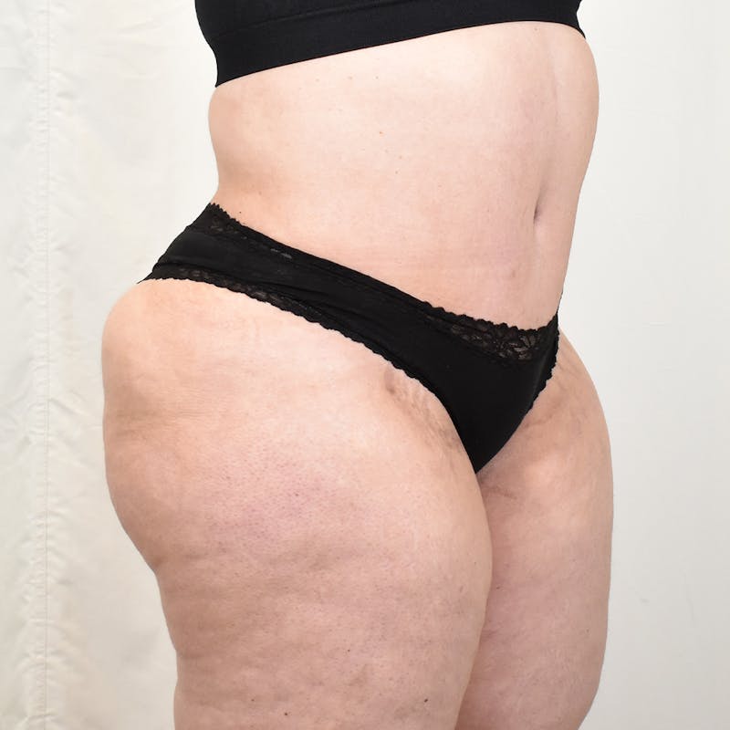 Tummy Tuck Before & After Gallery - Patient 293804 - Image 4