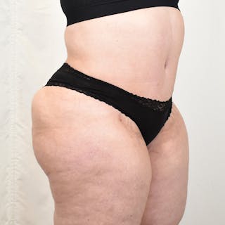 Tummy Tuck Before & After Gallery - Patient 293804 - Image 4
