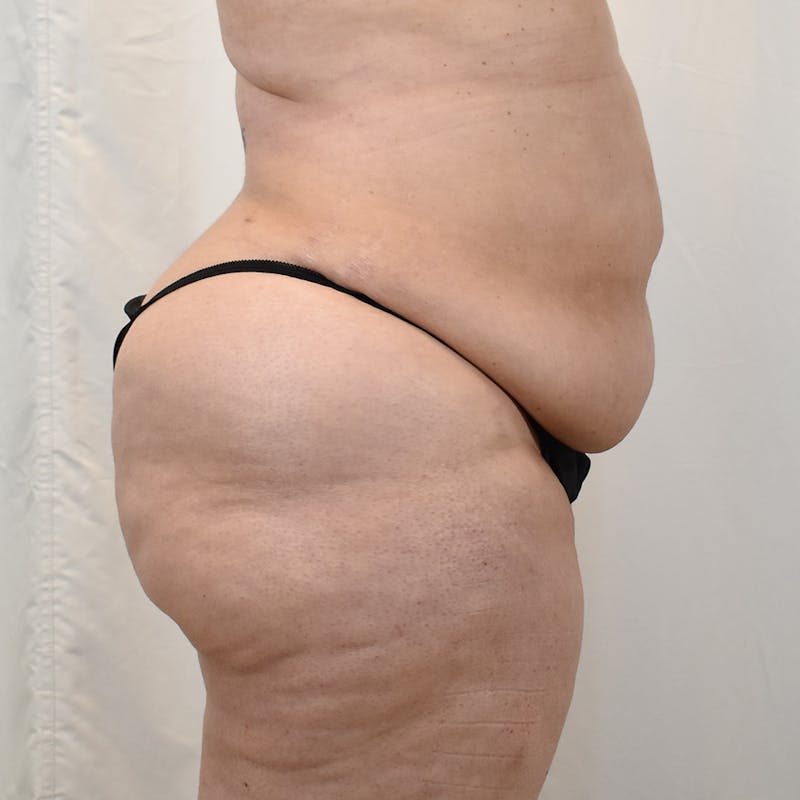 Tummy Tuck Before & After Gallery - Patient 293804 - Image 5