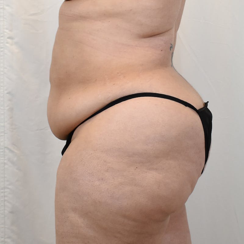 Tummy Tuck Before & After Gallery - Patient 293804 - Image 7