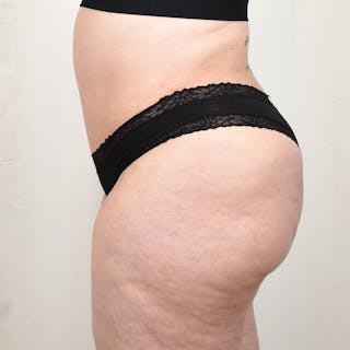 Tummy Tuck Before & After Gallery - Patient 293804 - Image 8