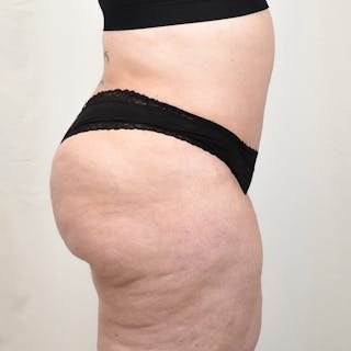 Tummy Tuck Before & After Gallery - Patient 293804 - Image 6