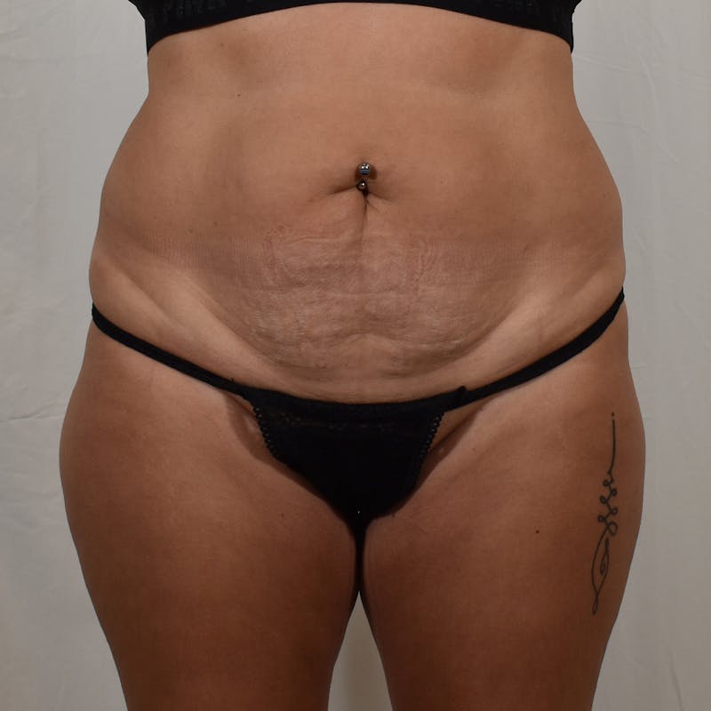 Tummy Tuck Before & After Gallery - Patient 275567 - Image 1