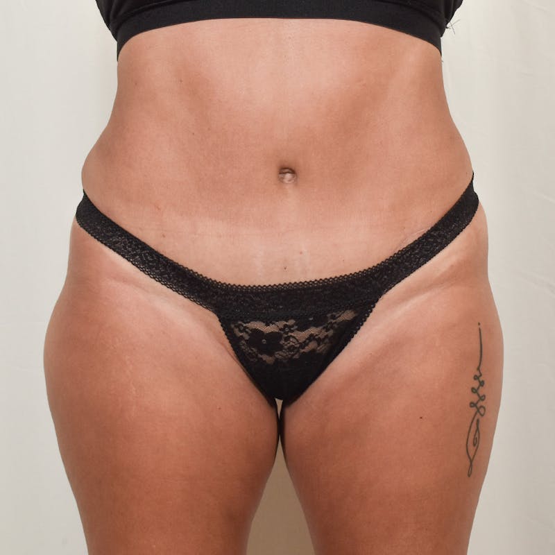 Tummy Tuck Before & After Gallery - Patient 275567 - Image 2
