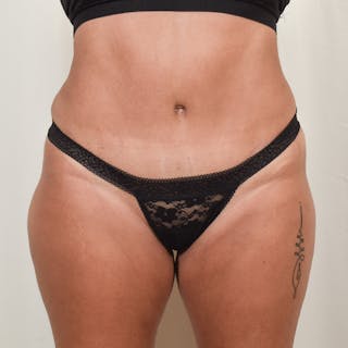 Tummy Tuck Before & After Gallery - Patient 275567 - Image 2