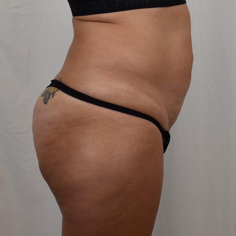 Tummy Tuck Before & After Gallery - Patient 275567 - Image 3