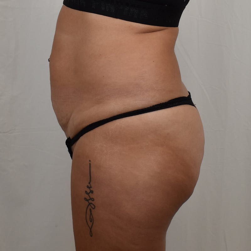 Tummy Tuck Before & After Gallery - Patient 275567 - Image 5