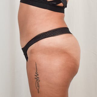 Tummy Tuck Before & After Gallery - Patient 275567 - Image 6