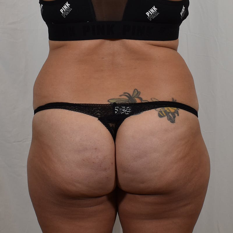 Tummy Tuck Before & After Gallery - Patient 275567 - Image 7