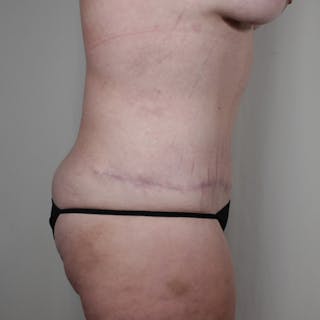Tummy Tuck Before & After Gallery - Patient 318980 - Image 4