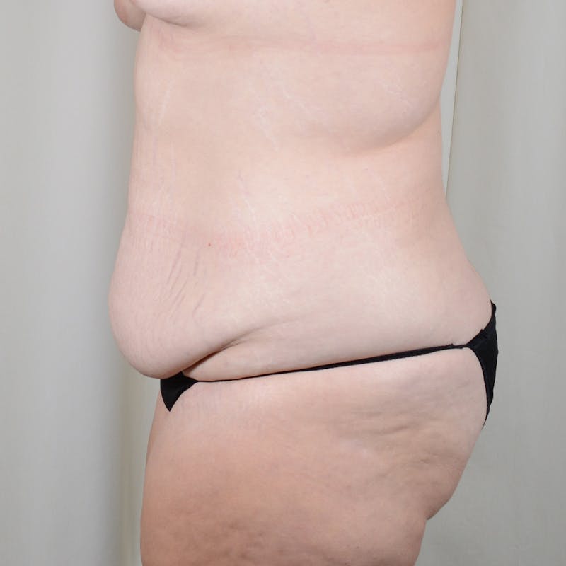 Tummy Tuck Before & After Gallery - Patient 318980 - Image 5