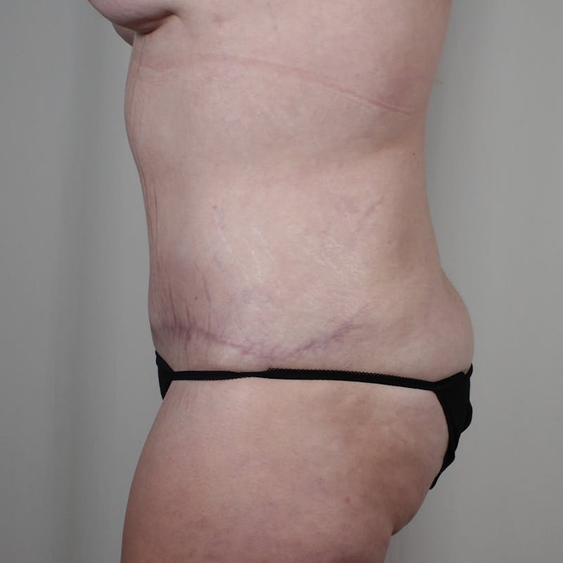 Tummy Tuck Before & After Gallery - Patient 318980 - Image 6
