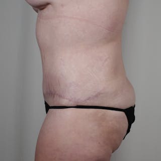 Tummy Tuck Before & After Gallery - Patient 318980 - Image 6