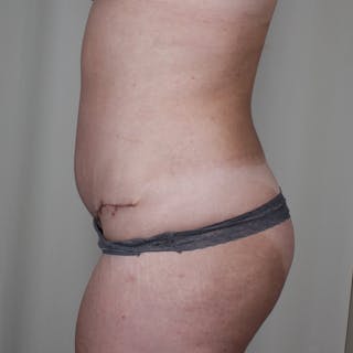 Tummy Tuck Before & After Gallery - Patient 407351 - Image 6