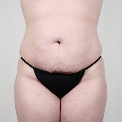 Tummy Tuck Before & After Gallery - Patient 407351 - Image 1