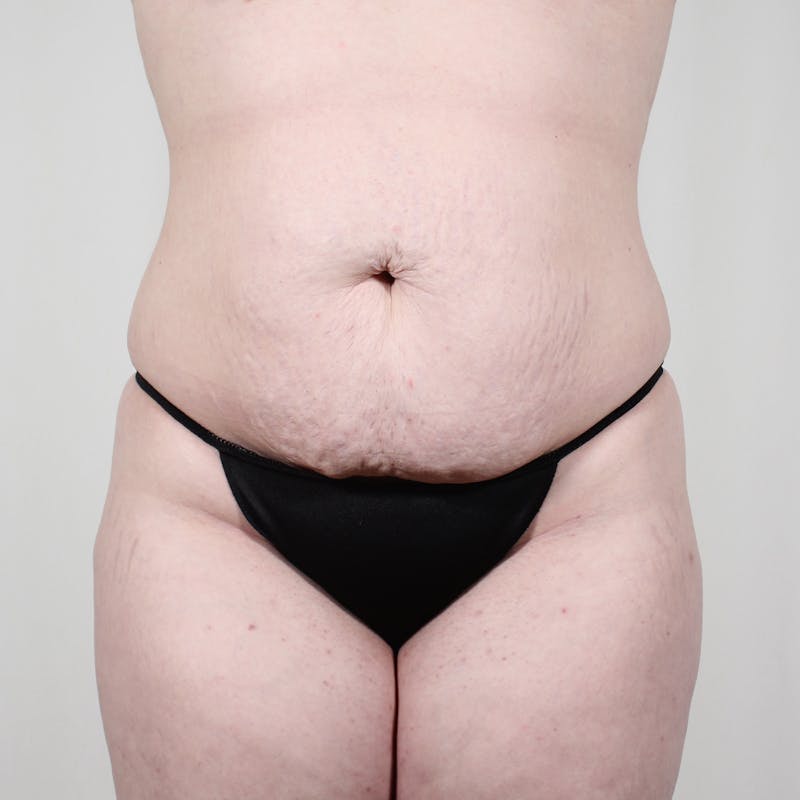 Tummy Tuck Before & After Gallery - Patient 407351 - Image 1