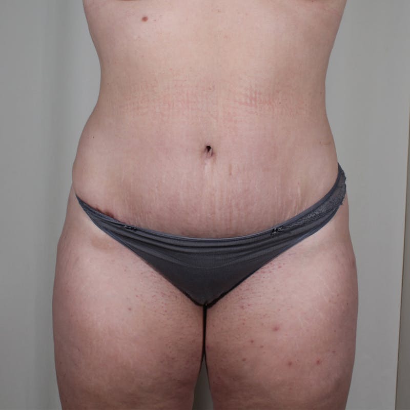 Tummy Tuck Before & After Gallery - Patient 407351 - Image 2
