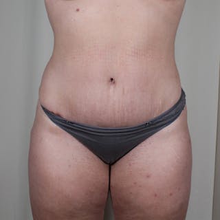 Tummy Tuck Before & After Gallery - Patient 407351 - Image 2
