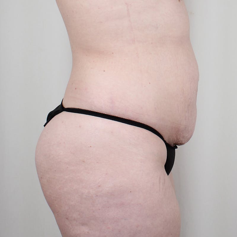Tummy Tuck Before & After Gallery - Patient 407351 - Image 3