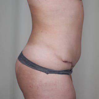 Tummy Tuck Before & After Gallery - Patient 407351 - Image 4