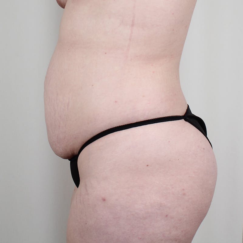 Tummy Tuck Before & After Gallery - Patient 407351 - Image 5