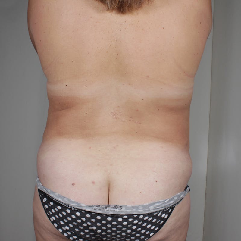 Tummy Tuck Before & After Gallery - Patient 215927 - Image 7