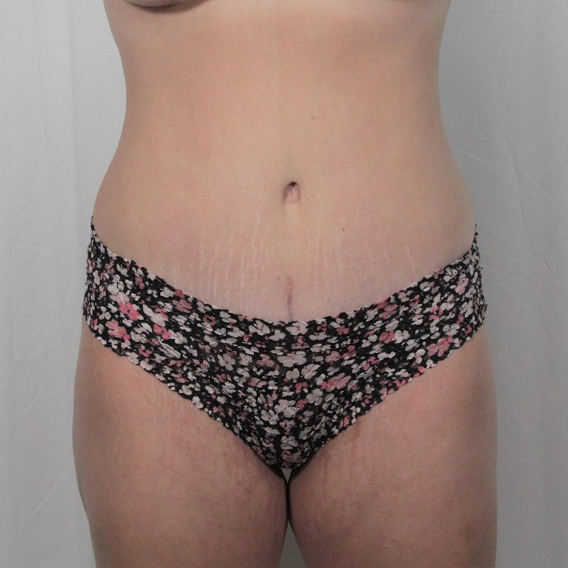 Tummy Tuck Before & After Gallery - Patient 307895 - Image 2