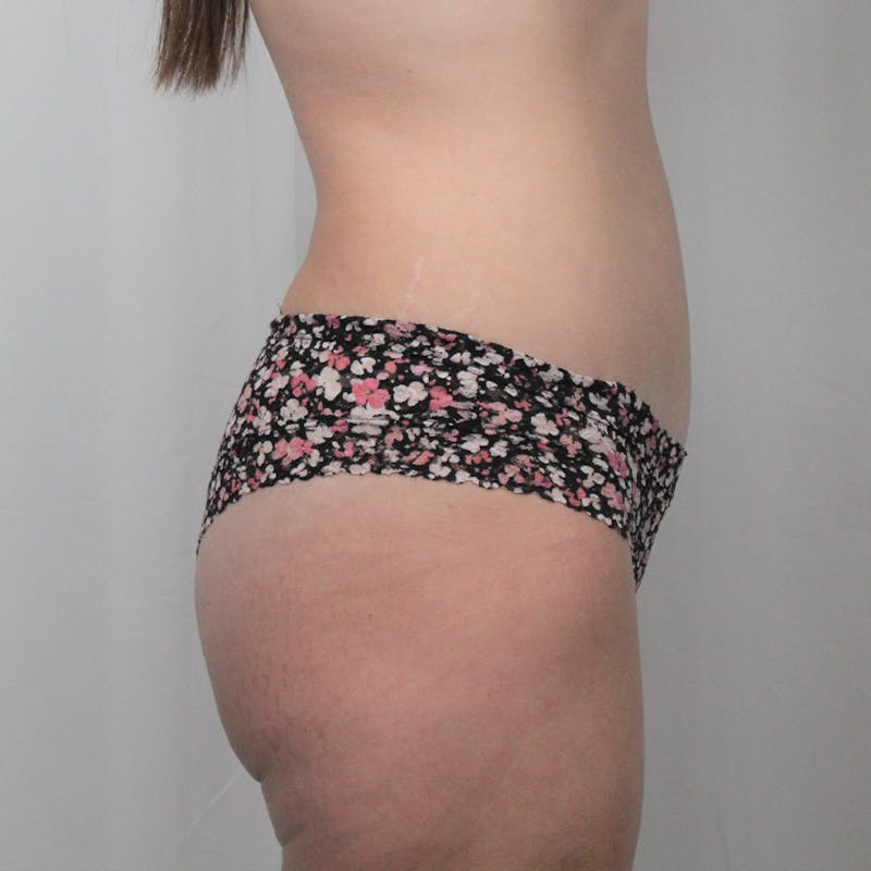 Tummy Tuck Before & After Gallery - Patient 307895 - Image 4