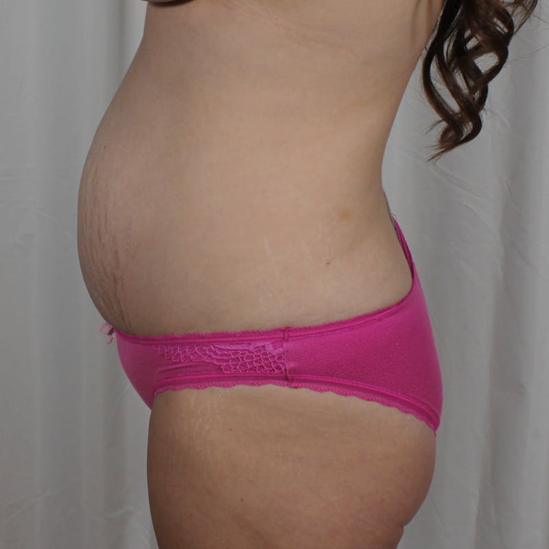 Tummy Tuck Before & After Gallery - Patient 307895 - Image 5