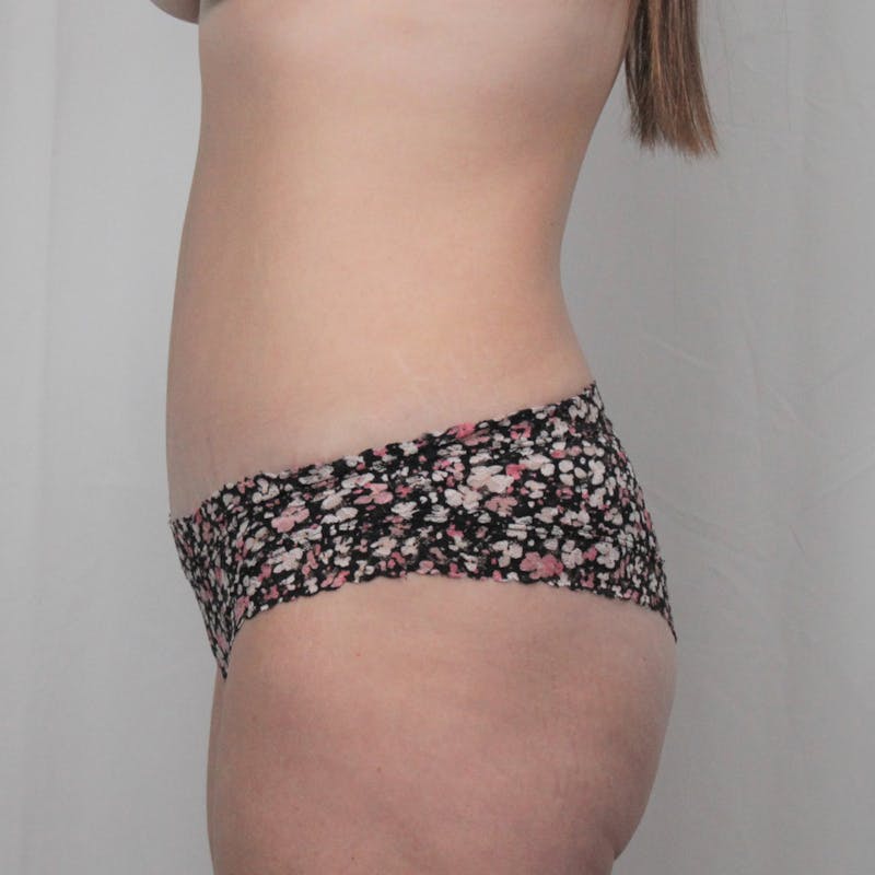 Tummy Tuck Before & After Gallery - Patient 307895 - Image 6
