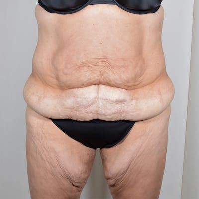 Tummy Tuck Before & After Gallery - Patient 890357 - Image 1