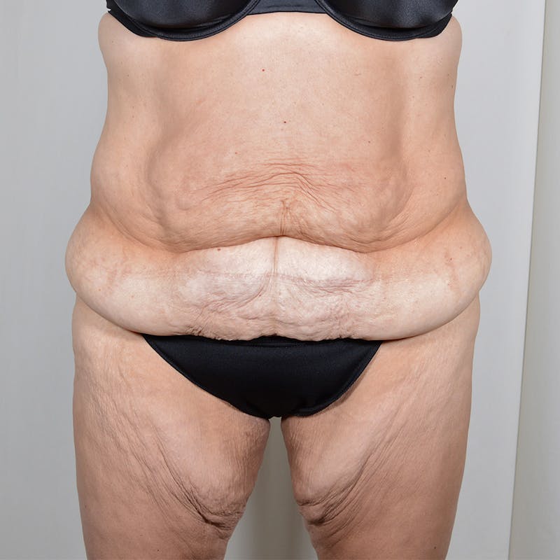 Tummy Tuck Before & After Gallery - Patient 890357 - Image 1