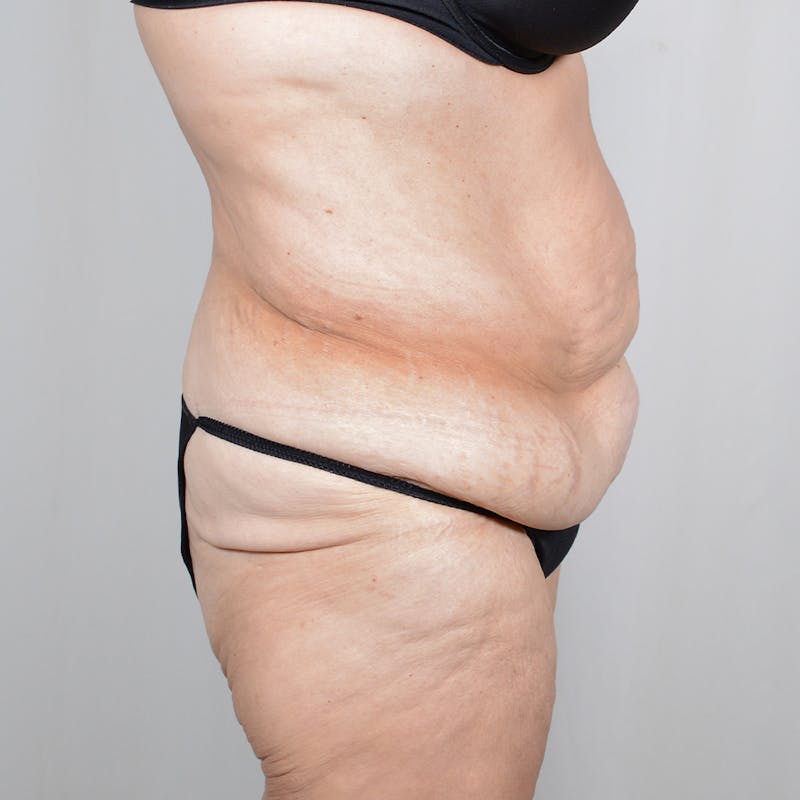 Tummy Tuck Before & After Gallery - Patient 890357 - Image 3