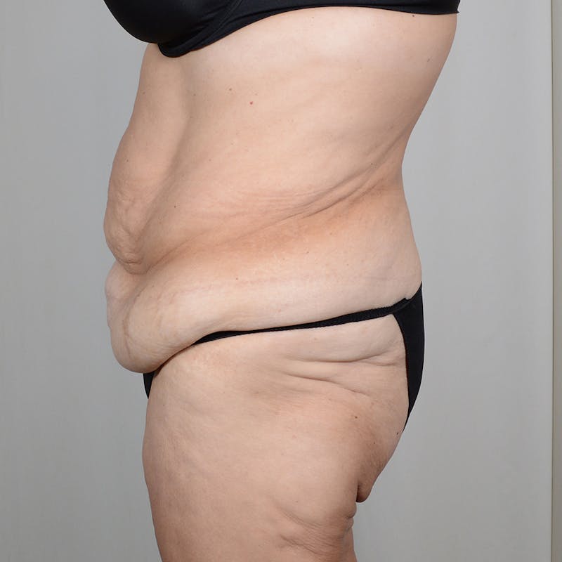 Tummy Tuck Before & After Gallery - Patient 890357 - Image 5